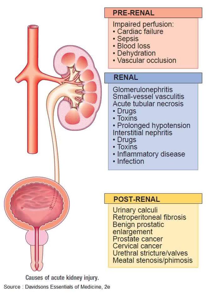 Cause of acute KI