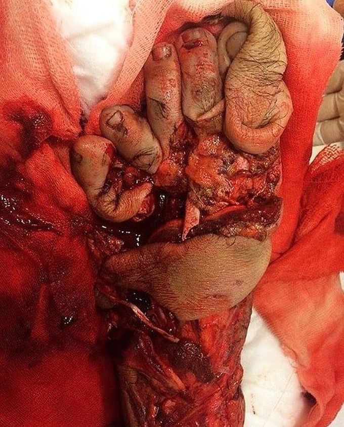 Accidental injury by a baler!  