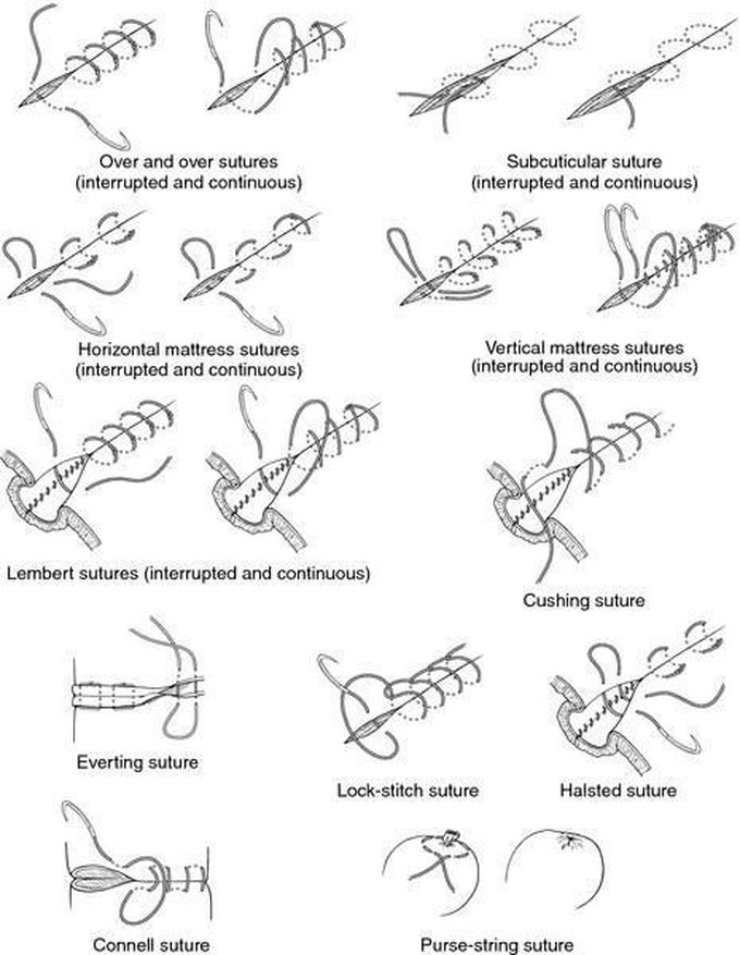 Types of sutures.