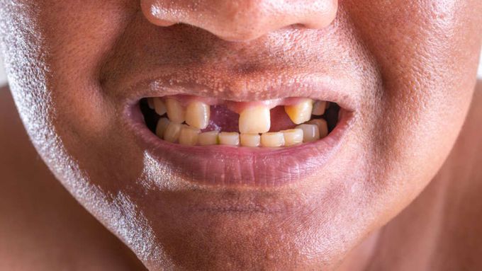 Scientists Discover a Way to Regenerate Teeth