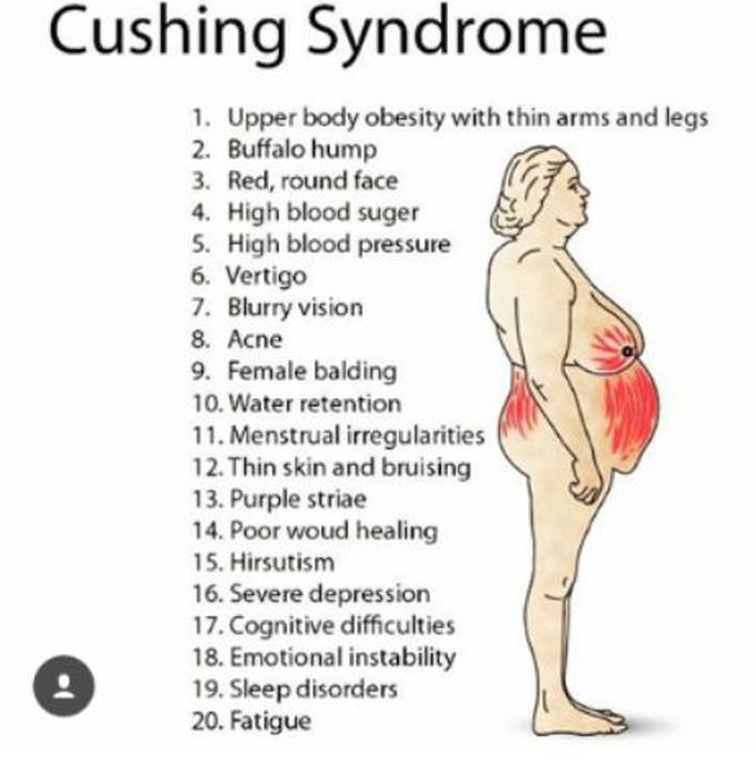Cushing syndrome