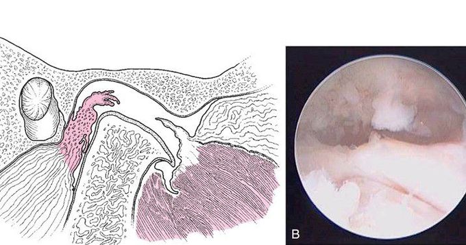 Arthroscopic Findings in Degenerative Joint Disease