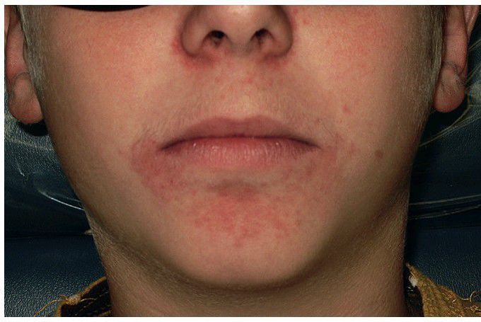 Perioral Dermatitis