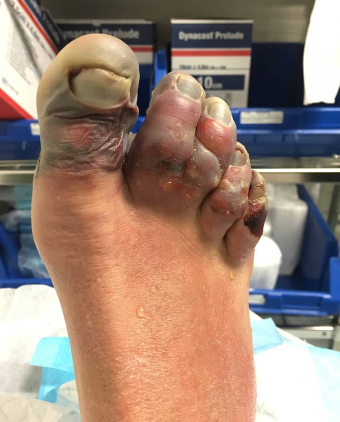 Frostbites of a climber who almost lost his toes while trying to save an injured teammate, climbing Mount Everest!