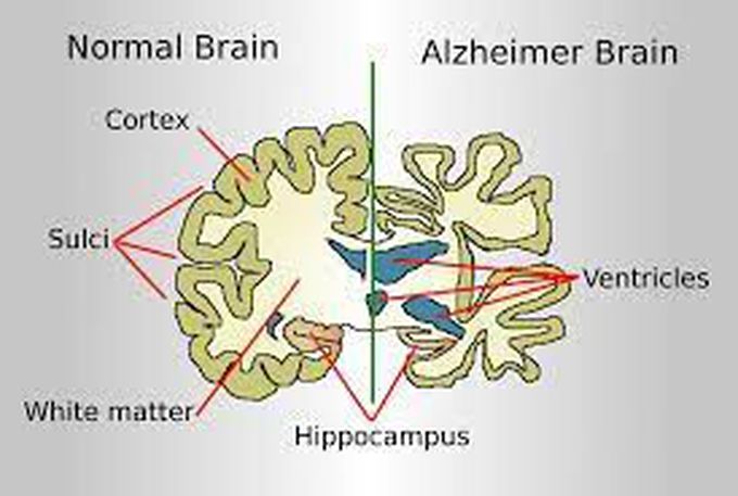 What is Alzheimer's disease?