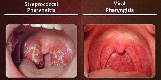 Pharyngitis