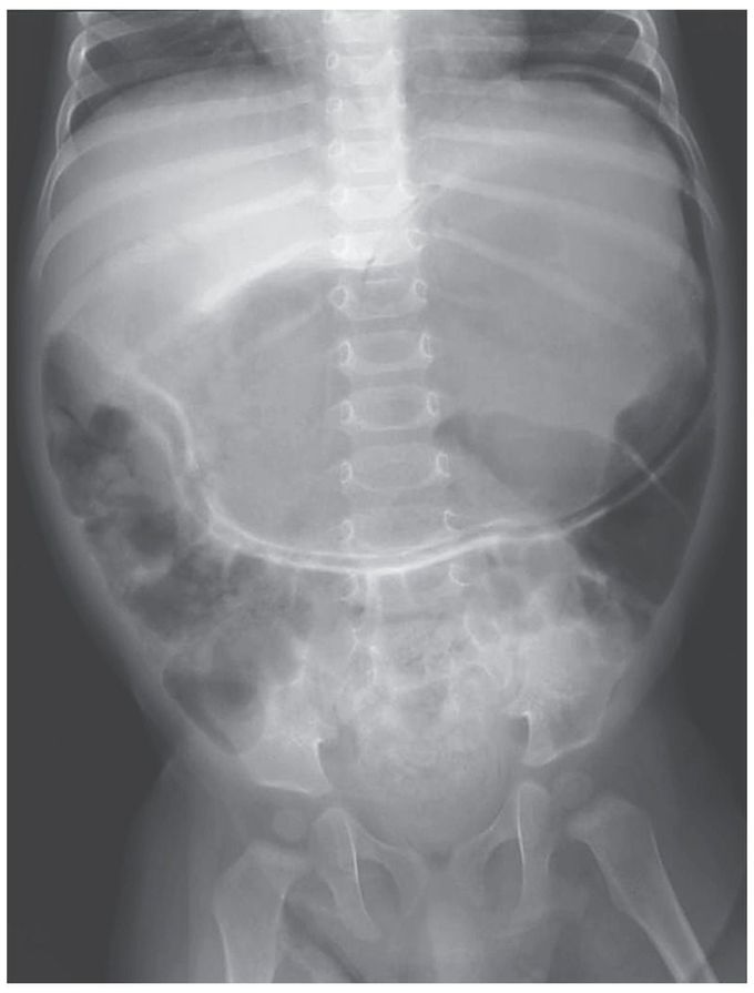 Gastric Emphysema