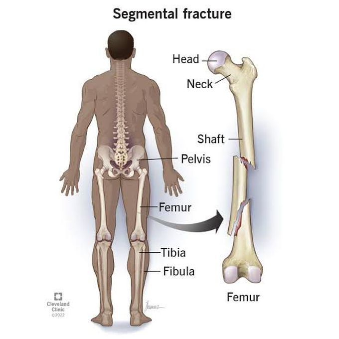 Segmental fracture