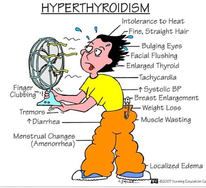 Hyperthyroidism