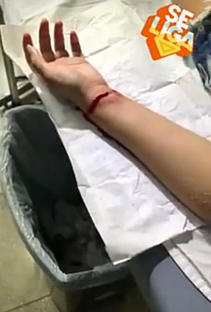 Intravenous arteries are cut and the condition is very serious and has reached the bone Note The chainsaw has been cut