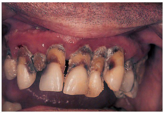 Advanced periodontitis with recession.