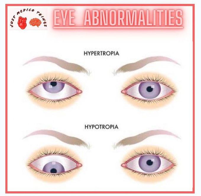 Eye Abnormalities