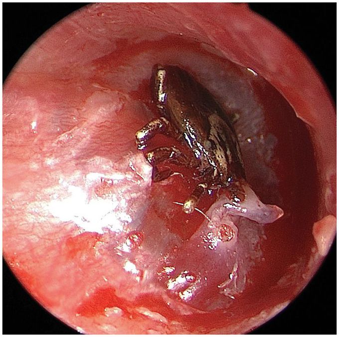 Tick Attached to the Tympanic Membrane