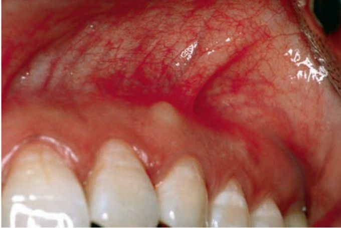 Buccal exostosis