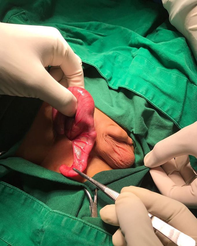 What the specific type of hernia when you find appendix vermiformis in hernial sac ?