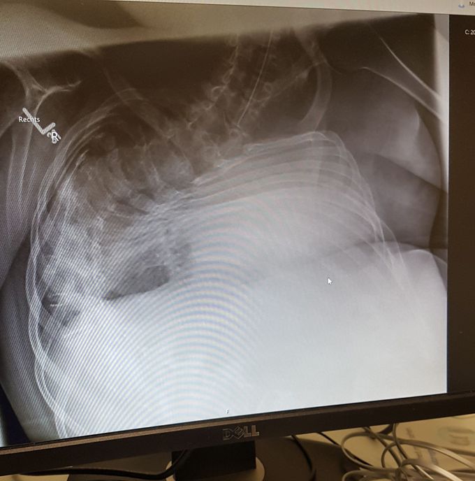 CR of a 14 y Boy in ICU