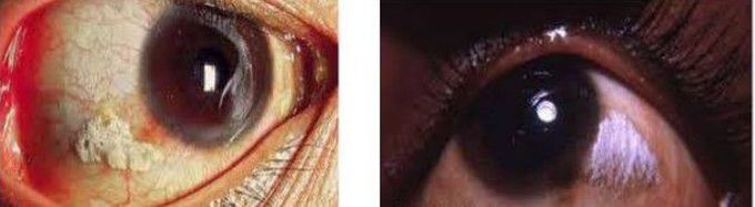 What is the condition called? Which vitamin deficiency leads to it?