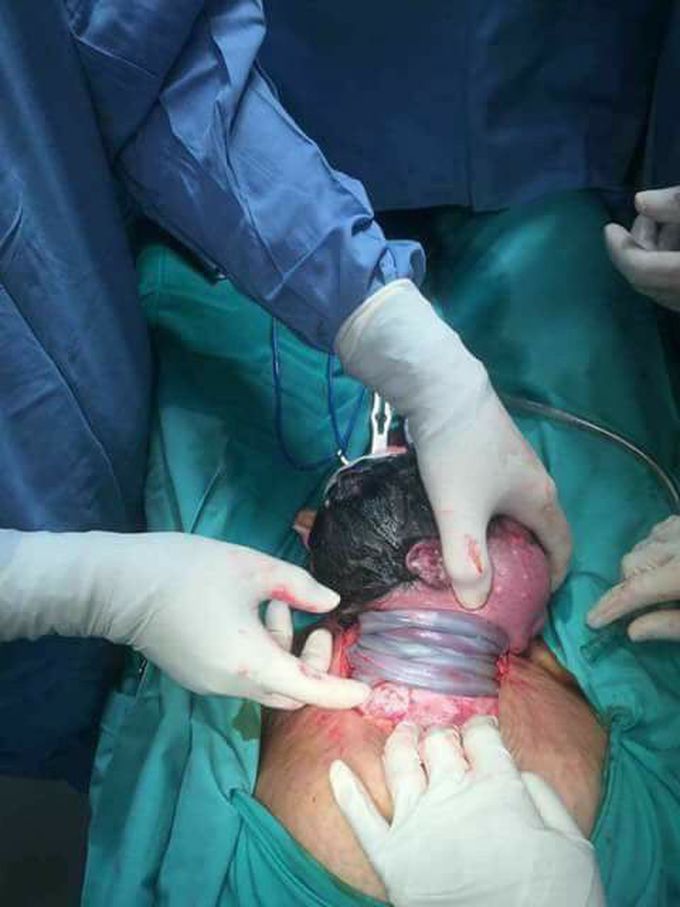 the baby is alive or dead?!