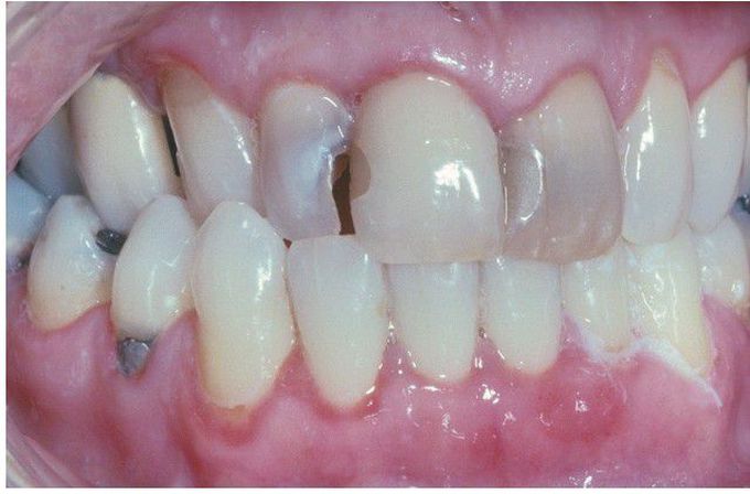 HIV-associated Gingivitis.