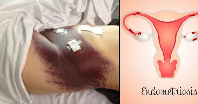This is What Endometriosis Surgery Looks Like When a Blood - MEDizzy