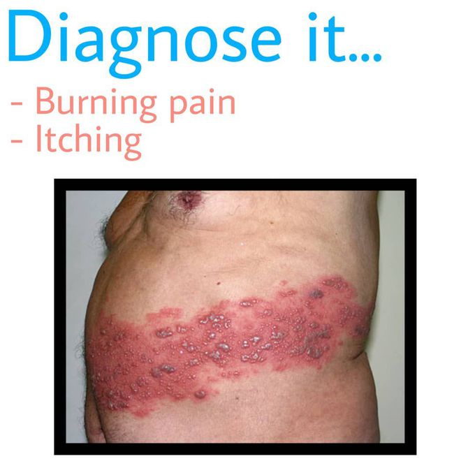 Burning and itching pain