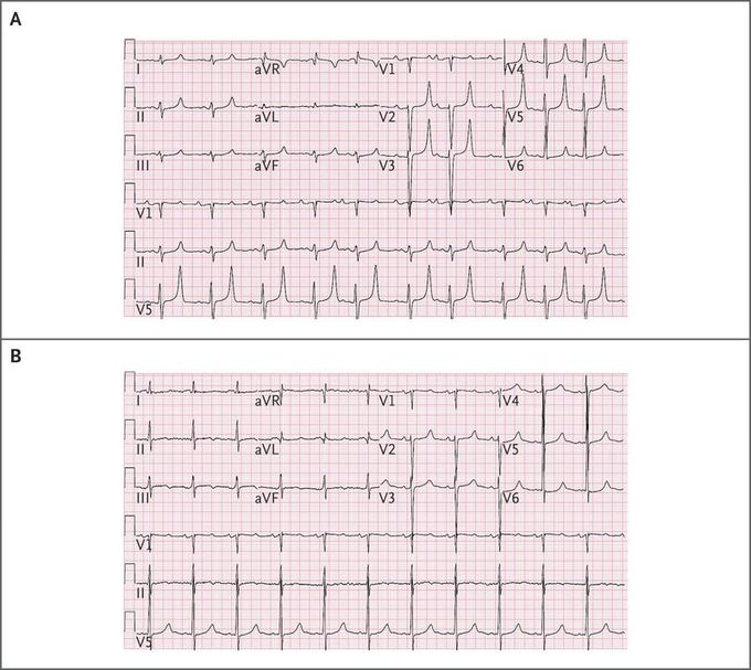 Hyperkalemia after Missed Hemodialysis