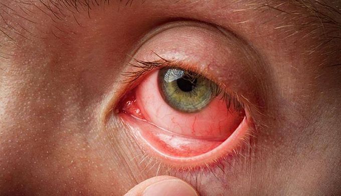 Causes of pink eye
