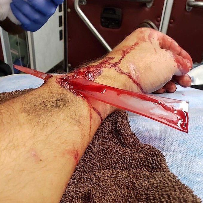 An unusual trauma case!!