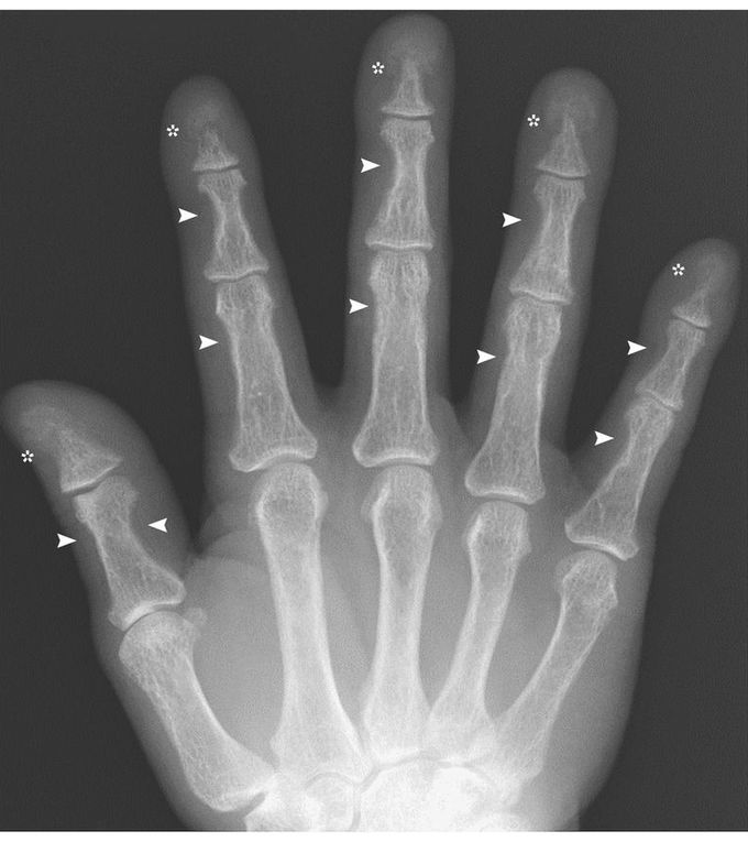 Subperiosteal Bone Resorption