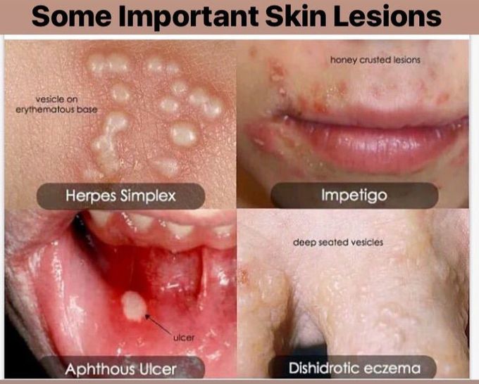 Some important skin lesions 😉