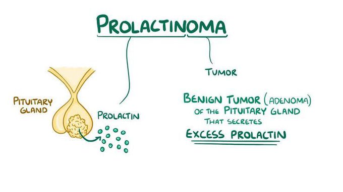 Prolactinoma symptoms