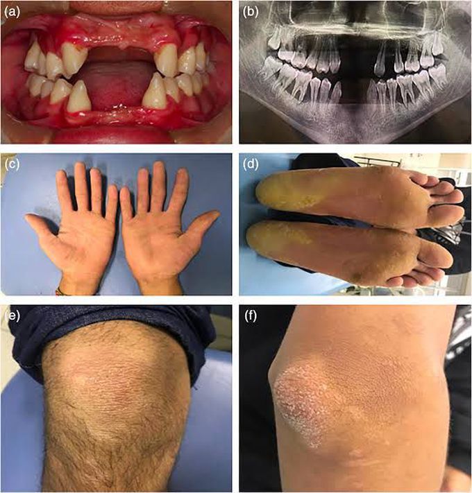 Papillon–Lefèvre syndrome