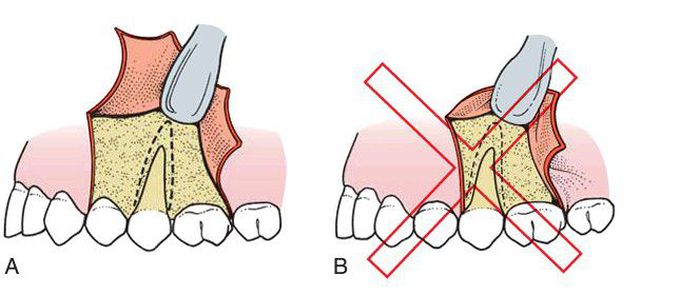 Principles of flap design