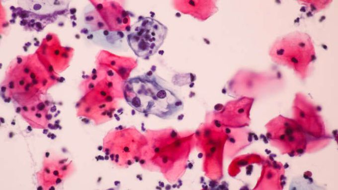 New Test Detects Cervical Cancer With 100 Percent Success Rate
