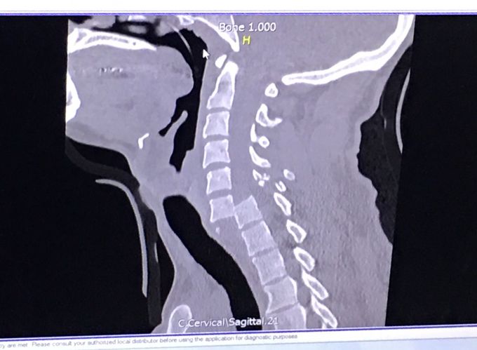 Luxación cervical