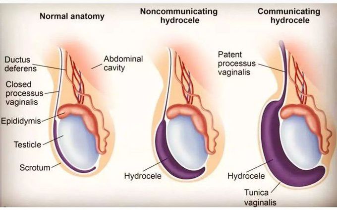 Hydrocele