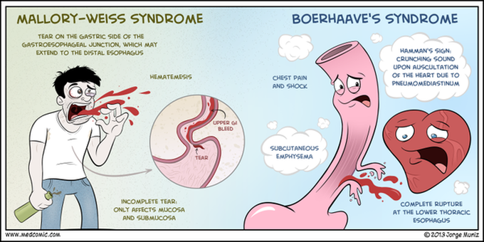 Upper GI bleed