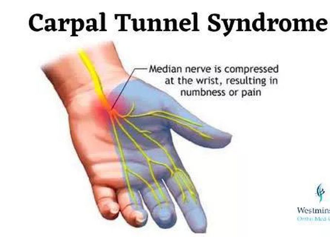 Carpal Tunnel Syndrome