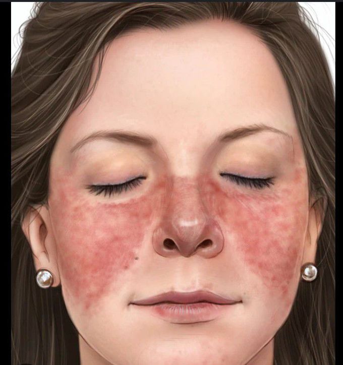 Lupus facial rash