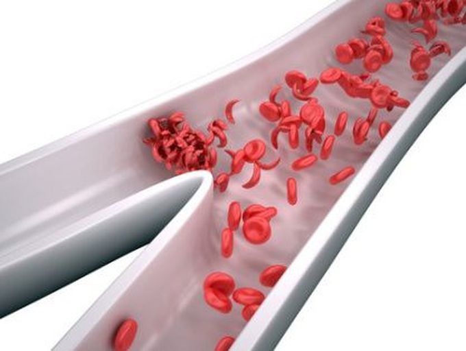 Can Colloidal Silver Cure Sickle Cell Anemia?