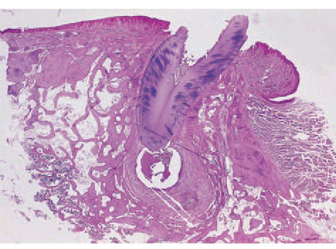 A developing radicular cyst.
