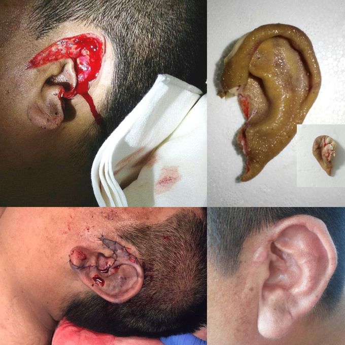 Resolution of the case: reconstruction of bitten ear. Final result.