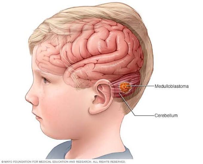 Symptoms of brain tumor