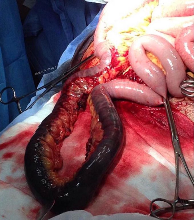Intestinal necrosis due to trauma!  