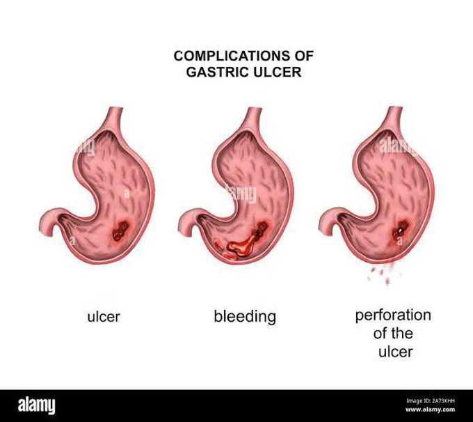 Complications of Gastric Ulcer