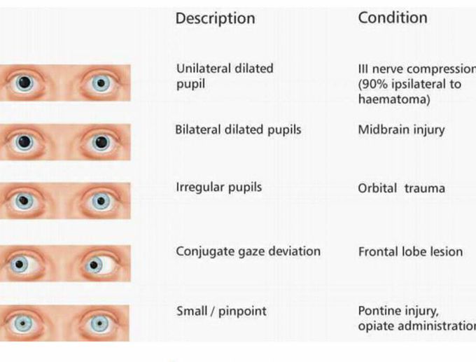 Eyes defects