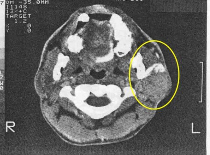 Recurrent Pleomorphic Adenoma