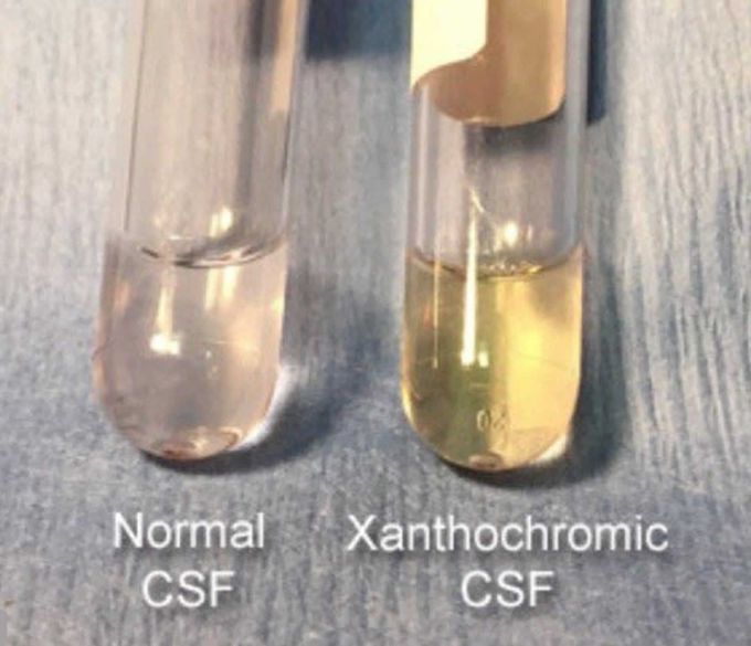 Differential Diagnoses of Xanthochromia