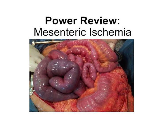 Mesentric ischemia