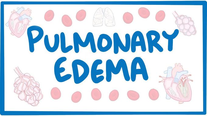 Pulmonary edema - causes, symptoms, diagnosis, treatment, pathology